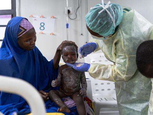A young measles patient is treated with zinc ointment at the MSF Nilefa Kiji facility in Maiduguri, Nigeria.