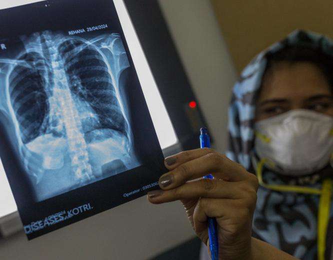 Dr. Muneeba Shaikh, a medical officer sees the results of X-ray of Rehana-28 year old, drug-resistant tuberculosis patient and participant of the endTB-Q trial at endTB clinical trial clinic in Kotri, Pakistan on Monday 29 April 2024.