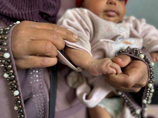 A mother holds her baby's hand that has a skin condition in Gaza. 