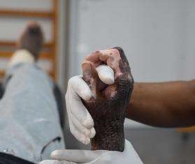 A physiotherapist maneuvers a patient's burned hand at MSF's hospital in Tabarre, Haiti.
