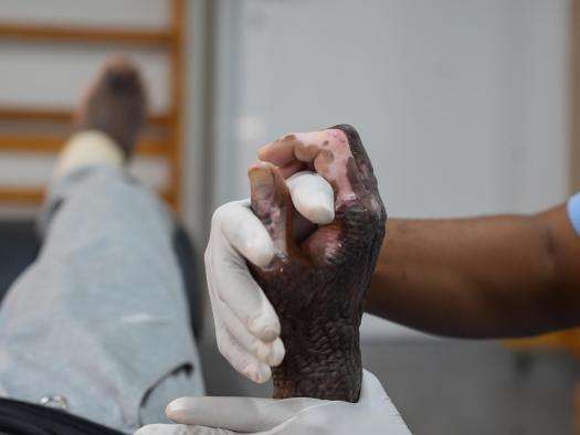 A physiotherapist maneuvers a patient's burned hand at MSF's hospital in Tabarre, Haiti.