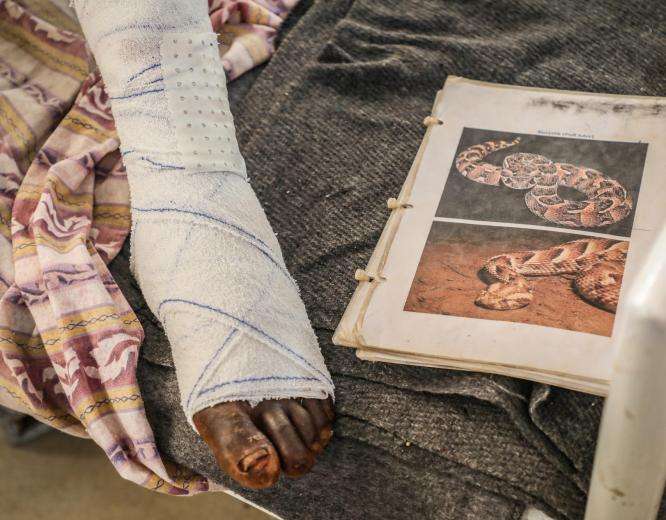 A patient who was bitten by a snake while harvesting sorghum in flooded fields.