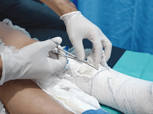 A patients' burned legs are treated at Nasser Hospital.