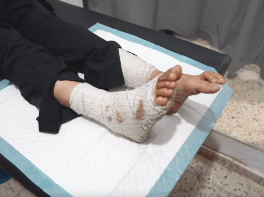 A patient's legs wrapped in bandage at Nasser Hospital.